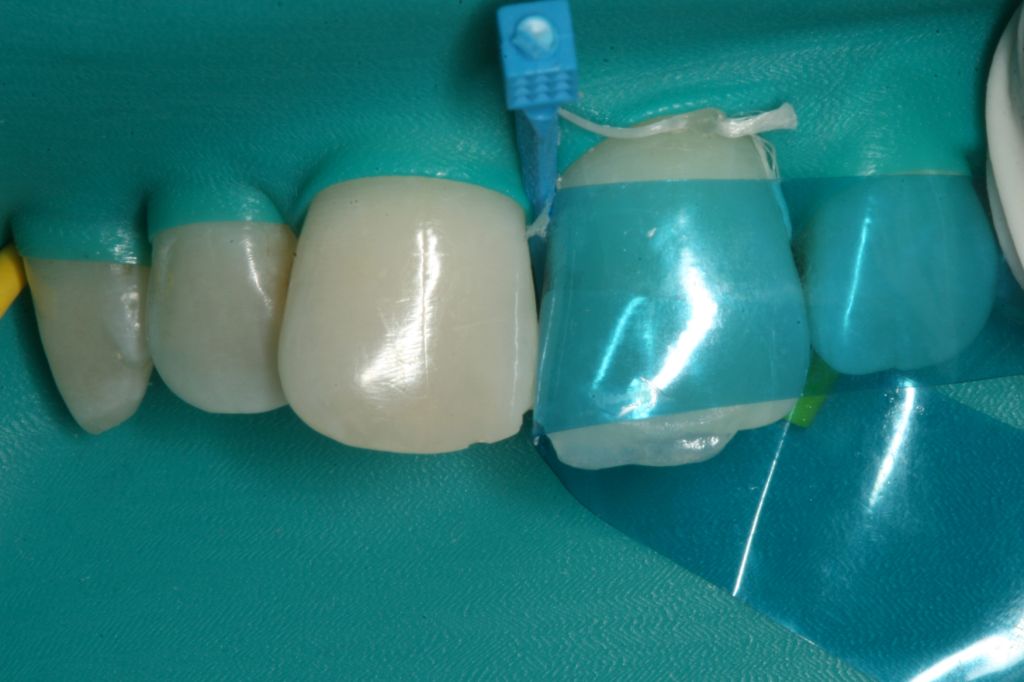 Матриці конт. Blue View VariStrip VS02, шт. (GARRISON)